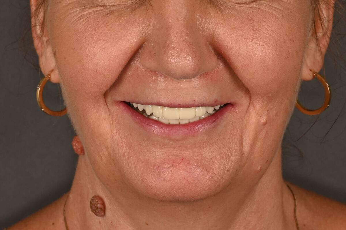 Zâmbet lateral dreapta_dupa